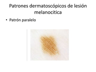 Patrones dermatoscópicos de lesión
melanocitica
• Patrón paralelo
 