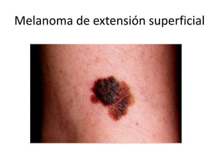 Melanoma de extensión superficial
 