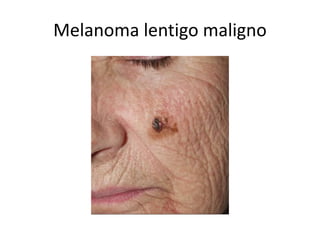 Melanoma lentigo maligno
 