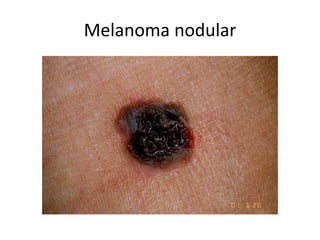 Melanoma nodular
 