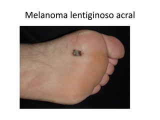 Melanoma lentiginoso acral
 