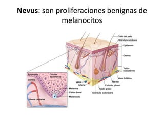 Nevus: son proliferaciones benignas de
melanocitos
 