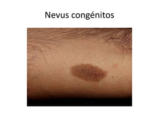 Nevus congénitos
 