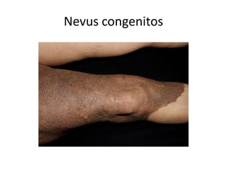 Nevus congenitos
 