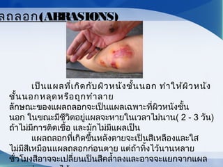 เป็นแผลที่เกิดกับผิวหนังชั้นนอก ทำาให้ผิวหนัง
ชั้นนอกหลุดหรือถูกทำาลาย
ลักษณะของแผลถลอกจะเป็นแผลเฉพาะที่ผิวหนังชั้น
นอก ในขณะมีชีวิตอยู่แผลจะหายในเวลาไม่นาน( 2 - 3 วัน)
ถ้าไม่มีการติดเชื้อ และมักไม่มีแผลเป็น
แผลถลอกที่เกิดขึ้นหลังตายจะเป็นสีเหลืองและใส
ไม่มีสีเหมือนแผลถลอกก่อนตาย แต่ถ้าทิ้งไว้นานหลาย
ชั่วโมงสีอาจจะเปลี่ยนเป็นสีคลำ้าลงและอาจจะแยกจากแผล
ลถลอก(ABRASIONS)
 