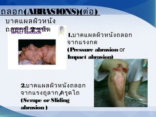 1.บาดแผลผิวหนังถลอก
จากแรงกด
(Pressure abrasion or
Impact abrasion)
ลถลอก(ABRASIONS)(ต่อ)
บาดแผลผิวหนัง
ถลอกมี 2 ชนิด
2.บาดแผลผิวหนังถลอก
จากแรงถูลาก/ครูดไถ
(Scrape orSliding
abrasion )
 