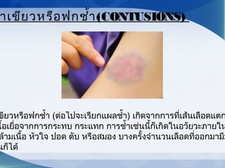 ขียวหรือฟกชำ้า (ต่อไปจะเรียกแผลชำ้า) เกิดจากการที่เส้นเลือดแตก
นื้อเยื่อจากการกระทบ กระแทก การชำ้าเช่นนี้ก็เกิดในอวัยวะภายใน
ล้ามเนื้อ หัวใจ ปอด ตับ หรือสมอง บางครั้งจำานวนเลือดที่ออกมามีม
นก็ได้
าเขียวหรือฟกชำ้า(CONTUSIONS)
 