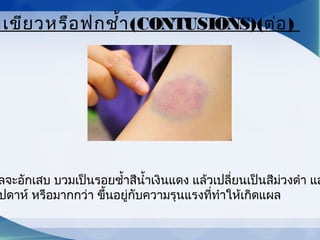ลจะอักเสบ บวมเป็นรอยชำ้าสีนำ้าเงินแดง แล้วเปลี่ยนเป็นสีม่วงดำา แล
ปดาห์ หรือมากกว่า ขึ้นอยู่กับความรุนแรงที่ทำาให้เกิดแผล
าเขียวหรือฟกชำ้า(CONTUSIONS)(ต่อ)
 
