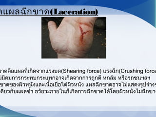 ขาดคือแผลที่เกิดจากแรงบด(Shearing force) แรงฉีก(Crushing force
ม่มีคมการกระทบกระแทกอาจเกิดจากการถูกตี หกล้ม หรือรถชนฯลฯ
ขาดของผิวหนังและเนื้อเยื่อใต้ผิวหนัง แผลฉีกขาดอาจไม่แสดงรูปร่างข
เดียวกับแผลชำ้า อวัยวะภายในก็เกิดการฉีกขาดได้โดยผิวหนังไม่ฉีกขาด
ดแผลฉีกขาด(Laceration)
 