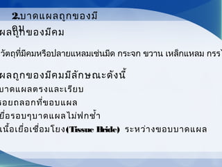 ผลถูกของมีคม
กวัตถุที่มีคมหรือปลายแหลมเช่นมีด กระจก ขวาน เหล็กแหลม กรรไ
ผลถูกของมีคมมีลักษณะดังนี้
บาดแผลตรงและเรียบ
รอยถลอกที่ขอบแผล
ยื่อรอบๆบาดแผลไม่ฟกชำ้า
เนื้อเยื่อเชื่อมโยง(Tissue Bride) ระหว่างขอบบาดแผล
2.บาดแผลถูกของมี
คม
 