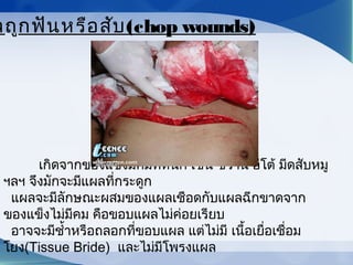 เกิดจากของแข็งมีคมที่หนัก เช่น ขวาน อีโต้ มีดสับหมู
ฯลฯ จึงมักจะมีแผลที่กระดูก
  แผลจะมีลักษณะผสมของแผลเชือดกับแผลฉีกขาดจาก
ของแข็งไม่มีคม คือขอบแผลไม่ค่อยเรียบ
อาจจะมีชำ้าหรือถลอกที่ขอบแผล แต่ไม่มี เนื้อเยื่อเชื่อม
โยง(Tissue Bride) และไม่มีโพรงแผล
ลถูกฟันหรือสับ(chop wounds)
 