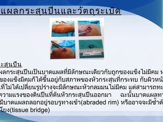 ดแผลกระสุนปืนและวัตถุระเบิด
ระสุนปืน
ผลกระสุนปืนเป็นบาดแผลที่มีลักษณะเดียวกับถูกของแข็งไม่มีคม ห
ของแข็งมีคมก็ได้ขึ้นอยู่กับสภาพของหัวกระสุนที่กระทบ กับผิวหนง
นที่ไม่ได้เปลี่ยนรูปร่างจะมีลักษณะหัวกลมมนไม่มีคม แต่สามารถทะ
ความแรงของดินปืนที่ดันหัวกระสุนปืนออกมา     ฉะนั้นบาดแผลทา
มีบาดแผลถลอกอยู่รอบรูทางเข้า(abraded rim) หรืออาจจะมีชำ้าด
โยง(tissue bridge)
 