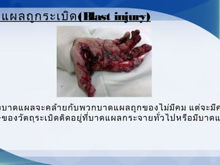 งบาดแผลจะคล้ายกับพวกบาดแผลถูกของไม่มีคม แต่จะมีค
ษของวัตถุระเบิดติดอยู่ที่บาดแผลกระจายทั่วไปหรือมีบาดแ
ดแผลถูกระเบิด(Blast injury)
 