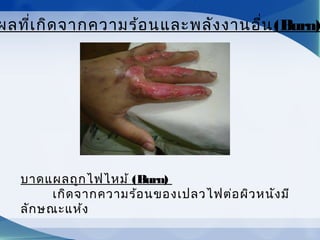 ผลที่เกิดจากความร้อนและพลังงานอื่น(Burn)
บาดแผลถูกไฟไหม้ (Burn)
เกิดจากความร้อนของเปลวไฟต่อผิวหนังมี
ลักษณะแห้ง
 
