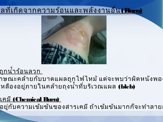 ถูกนำ้าร้อนลวก
กษณะคล้ายกับบาดแผลถูกไฟไหม้ แต่จะพบว่าผิดหนังพอง
เหลืองอยู่ภายในคล้ายถุงนำ้าที่บริเวณแผล (bleb)
เคมี (Chemical Burn)
อยู่กับความเข้มข้นของสารเคมี ถ้าเข้มข้นมากก็จะทำาลายผ
ผลที่เกิดจากความร้อนและพลังงานอื่น(Burn)
 
