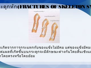 กเกิดจากการกระแทกกับของแข็งไม่มีคม แต่ของแข็งมีคมก
ต่แผลที่เกิดขึ้นบนกระดูกจะมีลักษณะต่างกันโดยสิ้นเชิงแผ
กโดยตรงหรือโดยอ้อม
ระดูกหัก(FRACTURES OF SKELETON SY
 
