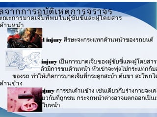 ษณะการบาดเจ็บที่พบในผู้ขับขี่และผู้โดยสาร
ด้านหน้า
Windshield injury ศีรษะจะกระแทกด้านหน้าของรถยนต์
Dashboard injury เป็นการบาดเจ็บของผู้ขับขี่และผู้โดยสารท
ด้านหน้าแล้วมีการชนด้านหน้า หัวเข่าจะพุ่งไปกระแทกกับส
ของรถ ทำาให้เกิดการบาดเจ็บที่กระดูกสะบ้า ต้นขา สะโพกได
ด้านข้าง
Dicing injury การชนด้านข้าง เช่นเดียวกับร่างกายจะเคล
ทิศทางเดียวกับที่ถูกชน กระจกหน้าต่างอาจแตกออกเป็นเห
ฝังเข้าไปที่ใบหน้า
ลจากการอุบัติเหตุการจราจร
 