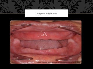 Problems associated with denture wearing and problems associated with ...