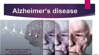 Alzheimer‘s disease
Menoufia faculty of medicine
Anatomy department
of 2nd year students(group 25)
 