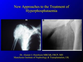 New Approaches to the Treatment of Hyperphosphataemia Dr. Alastair J. Hutchison MBChB, FRCP, MD Manchester Institute of Nephrology & Transplantation, UK 
