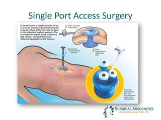 Single Port Access Surgery
 