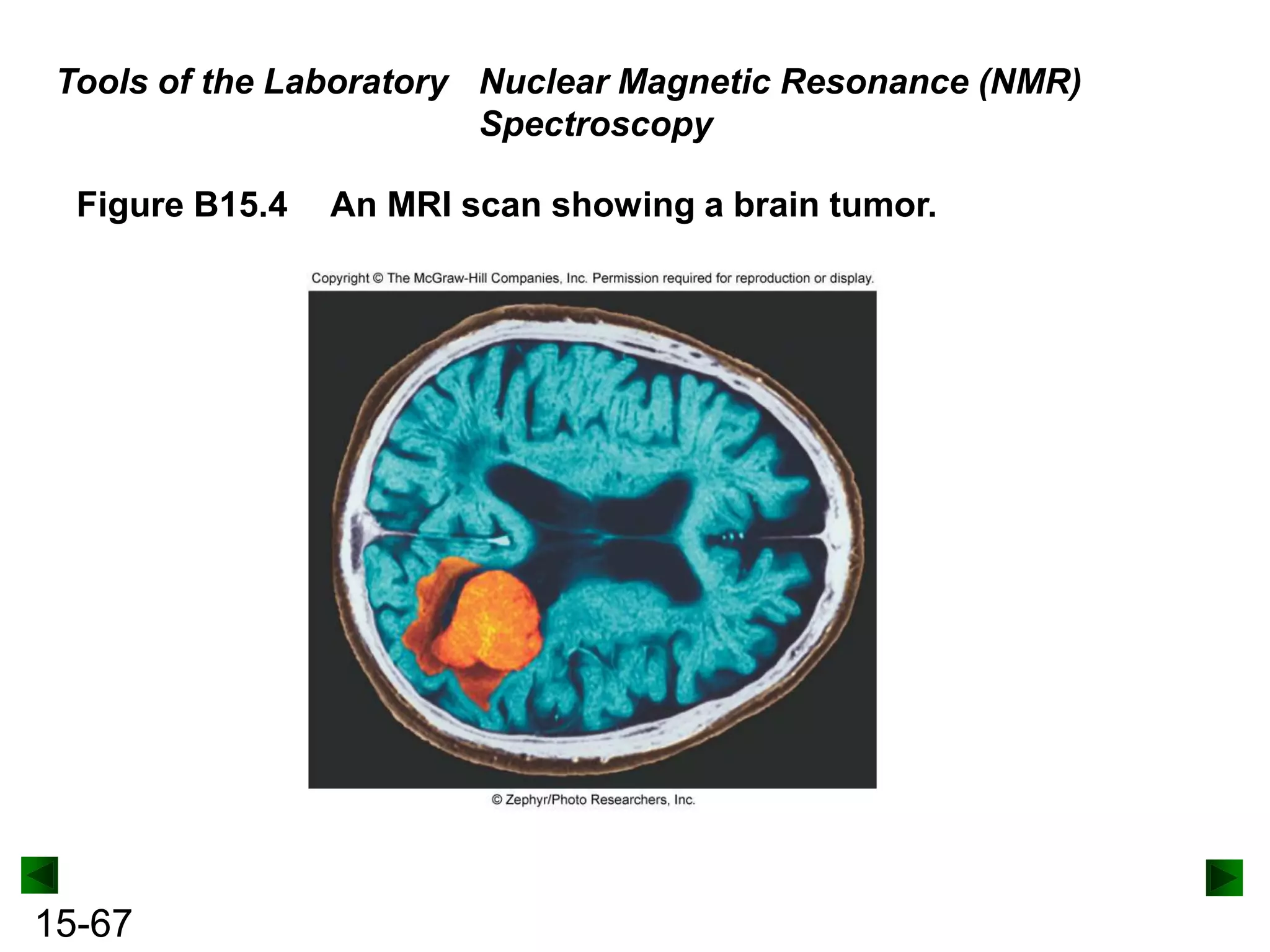 Tools of the Laboratory Nuclear Magnetic Resonance (NMR)
Spectroscopy
Figure B15.4

15-67

An MRI scan showing a brain tumor.

 