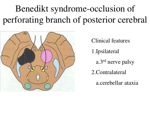 Image result for benedikt syndrome