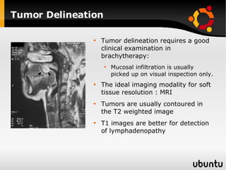 Tumor Delineation Tumor delineation requires a good clinical examination in brachytherapy: Mucosal infiltration is usually picked up on visual inspection only. The ideal imaging modality for soft tissue resolution : MRI Tumors are usually contoured in the T2 weighted image  T1 images are better for detection of lymphadenopathy 