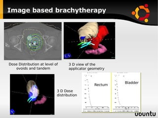 Image based brachytherapy Dose Distribution at level of ovoids and tandem 3 D view of the applicator geometry 3 D Dose distribution Rectum Bladder 