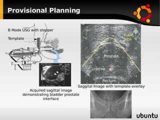 Provisional Planning B Mode USG with stepper Template Acquired sagittal image demonstrating bladder prostate interface Saggital Image with template overlay Pubic arch Prostate Urethra Rectum 