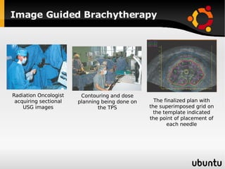 Image Guided Brachytherapy Radiation Oncologist acquiring sectional USG images Contouring and dose planning being done on the TPS The finalized plan with the superimposed grid on the template indicated the point of placement of each needle 