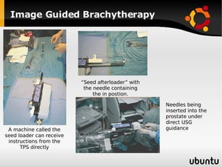 Image Guided Brachytherapy A machine called the seed loader can receive instructions from the TPS directly “Seed afterloader” with the needle containing the in postion. Needles being inserted into the prostate under direct USG guidance 