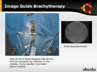 Image Guide Brachytherapy View of the B Mode Stepped USG device with the template for insertion of the needles. Some needles have been placed already Final Seed placement 