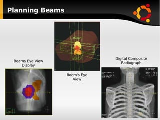 Planning Beams Beams Eye View Display Room's Eye View Digital Composite Radiograph 