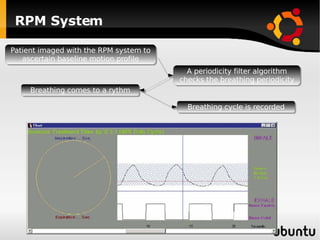 RPM System Patient imaged with the RPM system to ascertain baseline motion profile A periodicity filter algorithm checks the breathing periodicity Breathing comes to a rythm Breathing cycle is recorded 