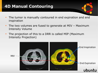 4D Manual Contouring The tumor is manually contoured in end expiration and end inspiration The two volumes are fused to generate at MIV – Maximum Intensity Volume  The projection of this to a DRR is called MIP (Maximum Intensity Projection) End Expiration End Inspiration MIV 