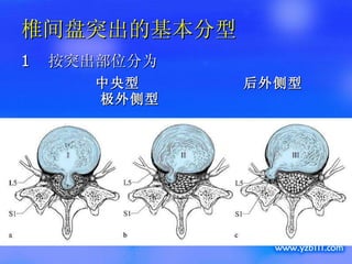 椎间盘突出的基本分型 1  按突出部位分为 中央型  后外侧型  极外侧型 
