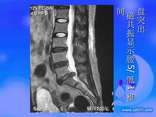 盘突出  磁共振显示腰 5/ 骶 1 椎间 