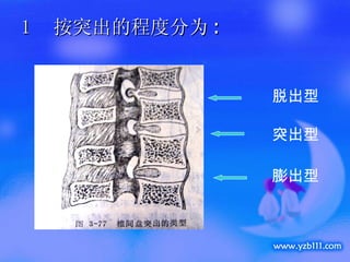 按突出的程度分为 : 脱出型 突出型 膨出型 