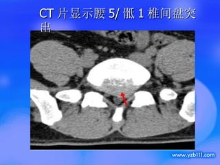 CT 片显示腰 5/ 骶 1 椎间盘突出 