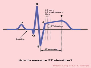 Крупночагового инфаркта миокарда /схема /
а-Нормальная ЭКГ, б-острейшая стадия, в-острая стадия,
г-подострая стадия, д-Руб...