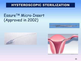 65
EssureTM Micro-Insert
(Approved in 2002)
 