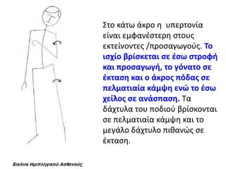 Στο κάτω άκρο η υπερτονία
είναι εμφανέστερη στους
εκτείνοντες /προσαγωγούς. Το
ισχίο βρίσκεται σε έσω στροφή
και προσαγωγή, το γόνατο σε
έκταση και ο άκρος πόδας σε
πελματιαία κάμψη ενώ το έσω
χείλος σε ανάσπαση. Τα
δάχτυλα του ποδιού βρίσκονται
σε πελματιαία κάμψη και το
μεγάλο δάχτυλο πιθανώς σε
έκταση.
 