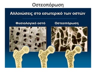 Οστεοπόρωση
 