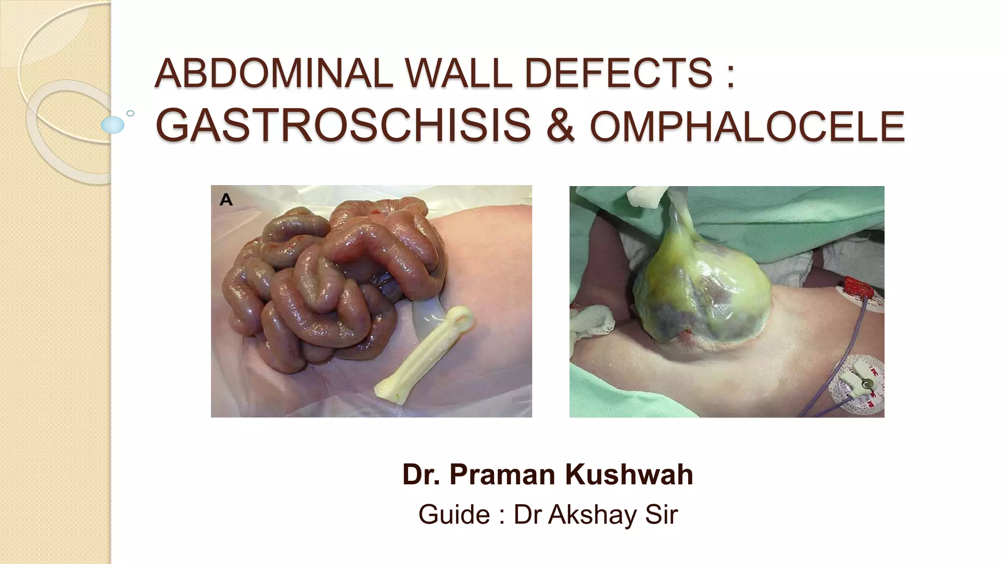 abdominal wall defect | PPTX