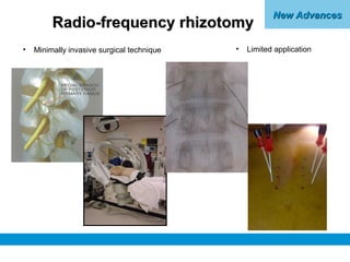 New AdvancesNew Advances
Radio-frequency rhizotomyRadio-frequency rhizotomy
• Minimally invasive surgical technique • Limi...