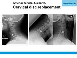 New AdvancesNew AdvancesAnterior cervical fusion vsAnterior cervical fusion vs..
Cervical disc replacementCervical disc re...