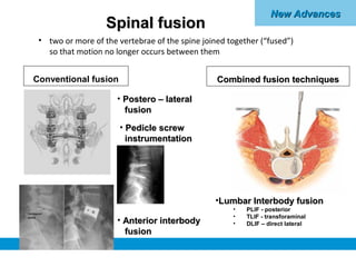 New AdvancesNew Advances
Spinal fusionSpinal fusion
Conventional fusion Combined fusion techniquesCombined fusion techniqu...
