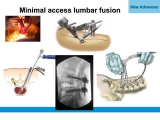 New AdvancesNew Advances
Minimal access lumbar fusionMinimal access lumbar fusion
 