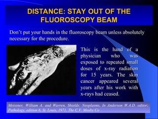 DISTANCE: STAY OUT OF THE
DISTANCE: STAY OUT OF THE
FLUOROSCOPY BEAM
FLUOROSCOPY BEAM
Don’t put your hands in the fluoroscopy beam unless absolutely
Don’t put your hands in the fluoroscopy beam unless absolutely
necessary for the procedure.
necessary for the procedure.
This is the hand of a
This is the hand of a
physician who was
physician who was
exposed to repeated small
exposed to repeated small
doses of x-ray radiation
doses of x-ray radiation
for 15 years. The skin
for 15 years. The skin
cancer appeared several
cancer appeared several
years after his work with
years after his work with
x-rays had ceased.
x-rays had ceased.
Meissner, William A. and Warren, Shields: Neoplasms, In Anderson W.A.D. editor;
Pathology, edition 6, St. Louis, 1971, The C.V. Mosby Co
 